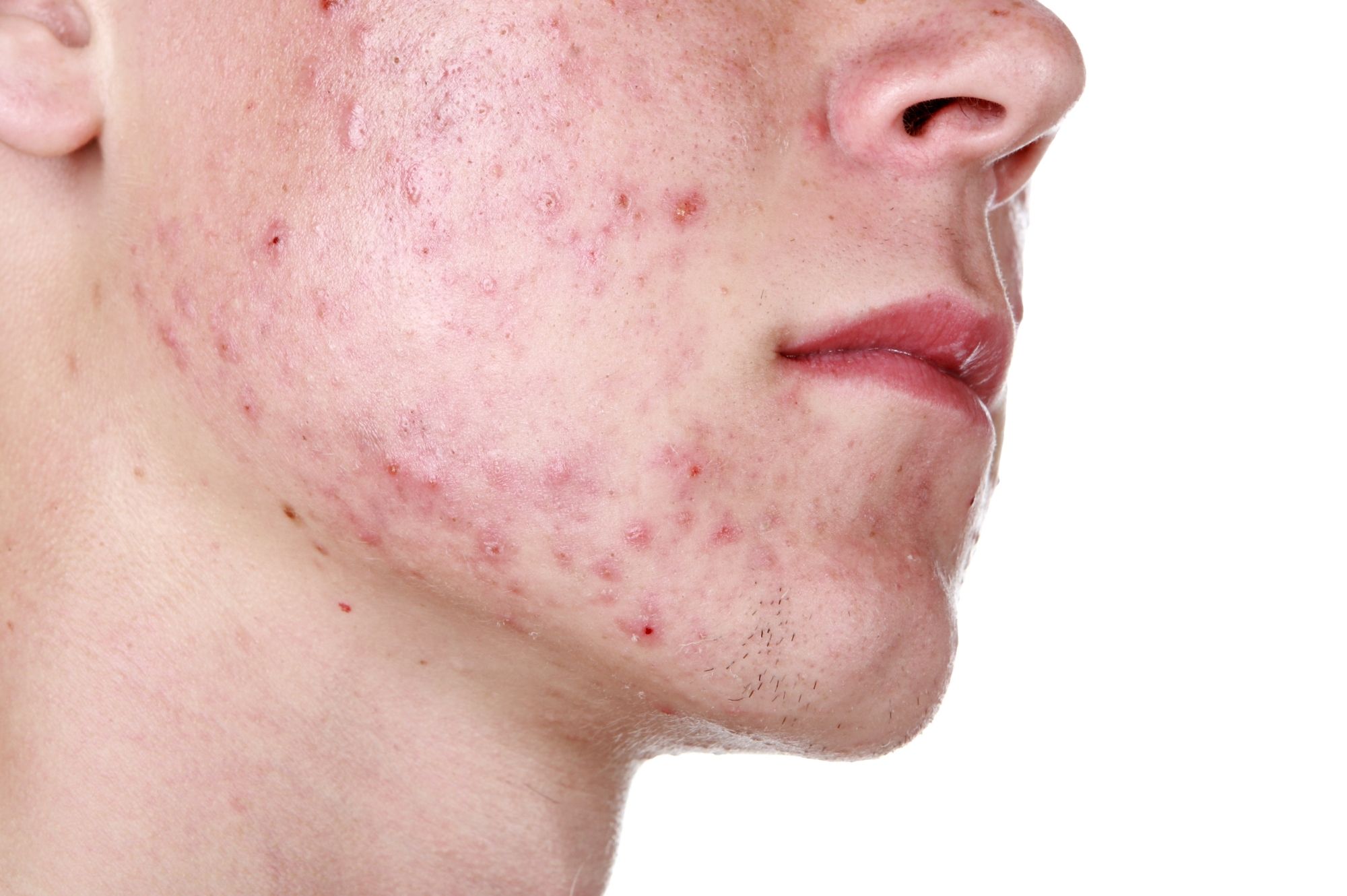 Comment faire partir les cicatrices d'acné